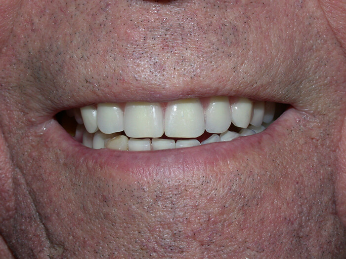 Silva Dental Lab Denture Clinic, Denture Design