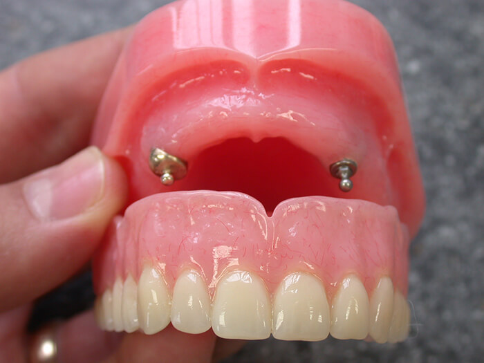 Silva Dental Lab Denture Clinic, Denture Design
