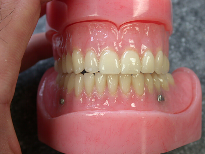 Silva Dental Lab Denture Clinic, Denture Design