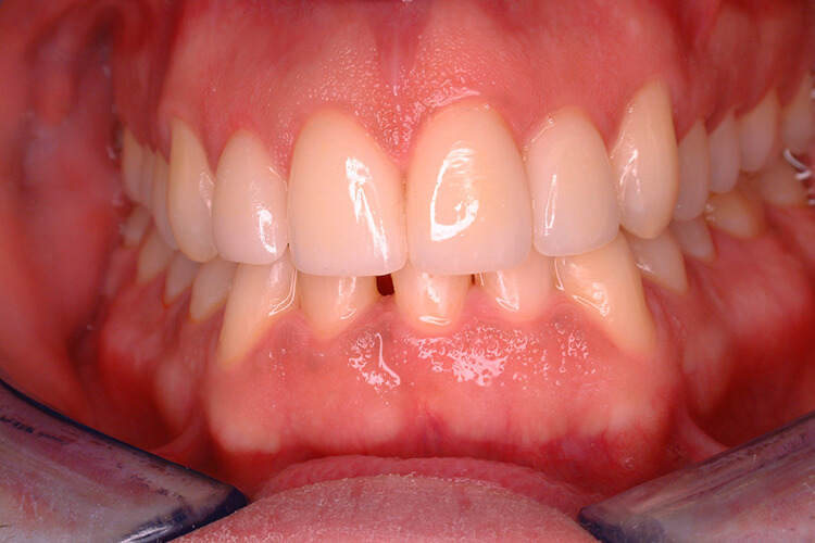 Silva Dental Lab eMax Dental Crown Fabrication