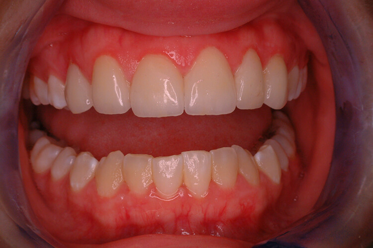 Silva Dental Lab eMax Dental Crown Fabrication