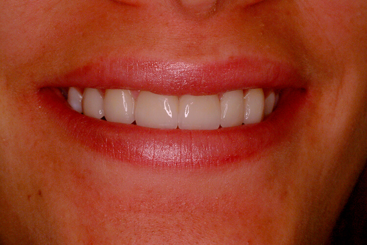 Silva Dental Lab eMax Dental Crown Fabrication