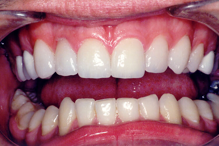 Silva Dental Lab eMax Dental Crown Fabrication