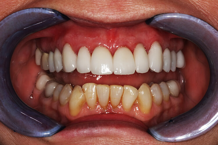 Silva Dental Lab eMax Dental Crown Fabrication