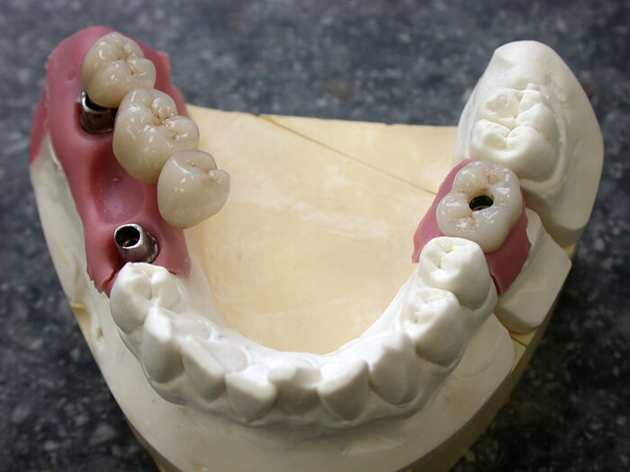Silva Dental Lab FullService & Support Dental Implant Systems
