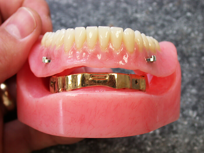 Silva Dental Lab FullService & Support Dental Implant Systems