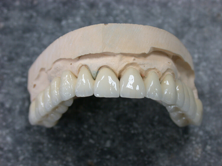 Silva Dental Lab Porcelain and Full Metal Crowns