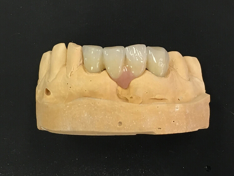 Silva Dental Lab Porcelain and Full Metal Crowns