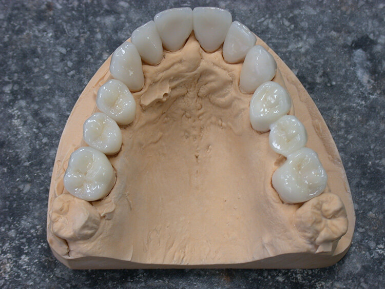 Silva Dental Lab Zirconia Dental Solutions